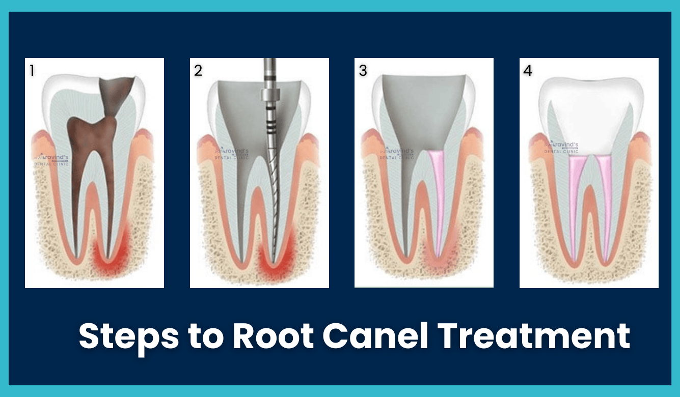 Infographic showing steps of root canal treatment at Dr Aravind’s Orthodontic and Dental Clinic in Hyderabad.