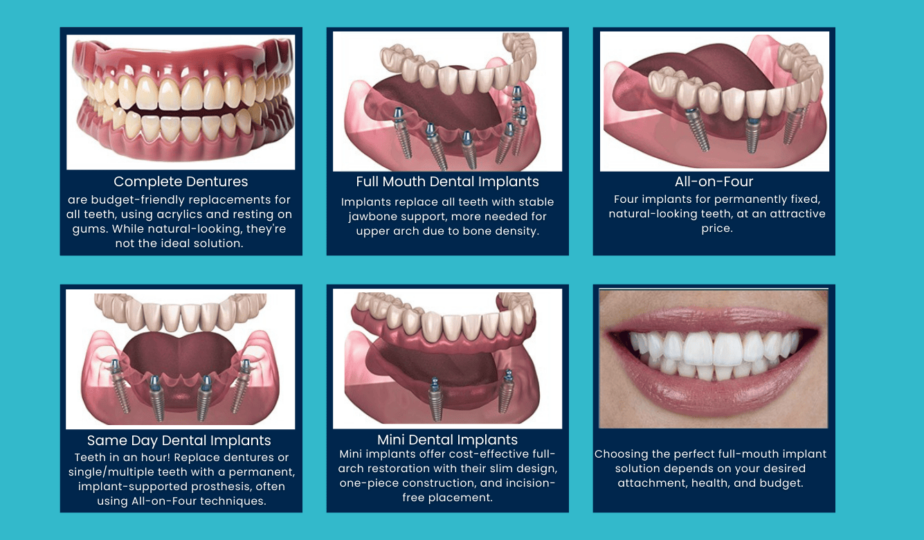 Infographic showing full mouth dental implant options including dentures, All-on-Four implants, same-day implants and mini implants.