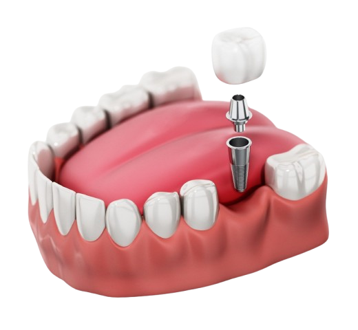 Dental Implants