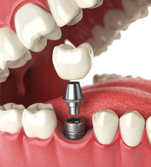 Dental Implants