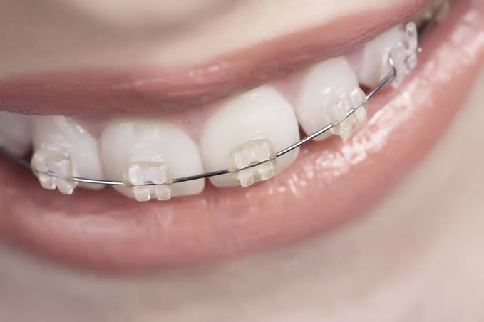 Best age for braces