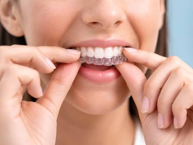 Clear aligners for adults for teeth straightening
